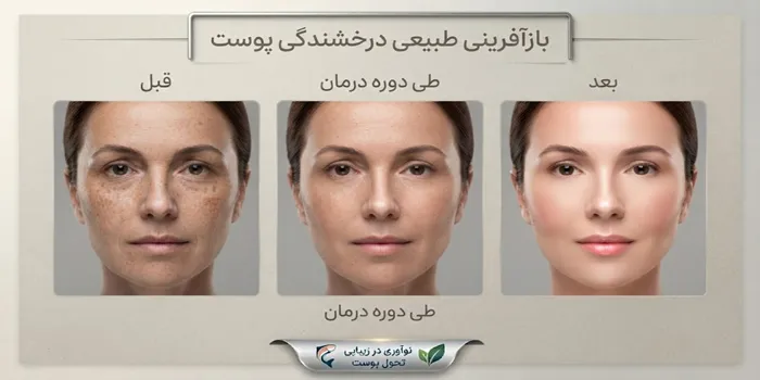 مراحل درمان لک صورت با PDRN 3456342