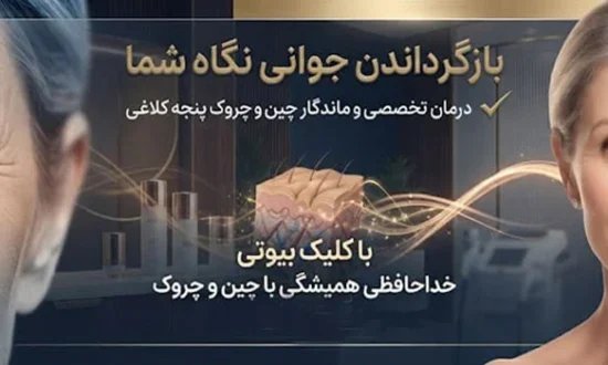 خطوط پنجه کلاغی دور چشم 87546531