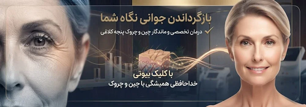 خطوط پنجه کلاغی دور چشم 87546531