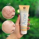 ژل کرم آکنه کامازو 685456312